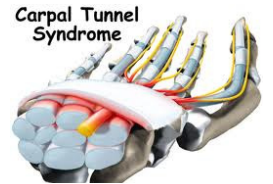 Carpal tunnel syndrome skeletal hand